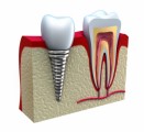 Dental Implants Plr Articles