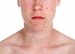 Acne Plr Articles