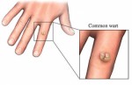 Wart Removal Plr Articles