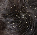 Head Lice Plr Articles