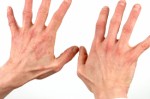 Dermatitis Plr Articles
