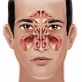 Sinus Infections Plr Articles v2