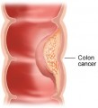 Colon Cancer Plr Articles