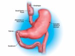 Gastric Bypass Plr Articles