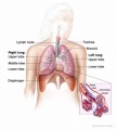 Mesothelioma Plr Articles