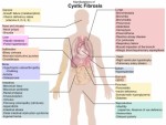 Cystic Fibrosis Plr Articles