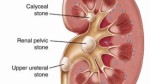 Kidney Stones Plr Articles
