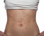 Eczema Plr Articles v2