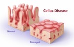 Celiac Disease Plr Articles
