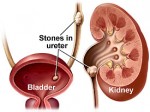 Kidney Stones Plr Articles v2