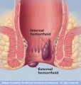 Hemorrhoids Plr Articles v2