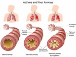 Asthma Plr Articles v2