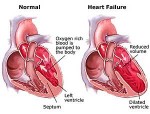 Congestive Heart Plr Articles