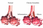 Bronchitis Plr Articles