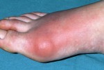 Gout Plr Articles