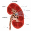 Kidney Stone Plr Articles