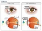 Cataract Plr Articles