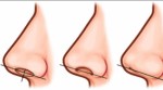 Rhinoplasty Plr Articles