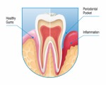 Gum Disease Plr Articles