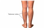 Varicose Veins Plr Articles v2