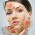 Rosacea Plr Articles