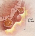 Diveticulitis Plr Articles