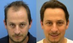 Hair Transplant Plr Articles