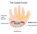 Carpal Tunnel Plr Articles
