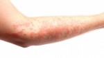 Eczema Plr Articles v4