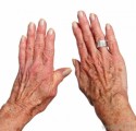 Arthritis Information Plr Articles