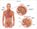 Lymphoma Plr Articles