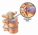 Herniated Disc Plr Articles