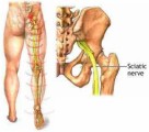 Sciatica Plr Articles