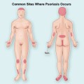 Psoriasis Plr Articles