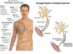 Multiple Sclerosis Plr Articles v2