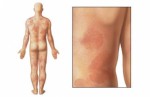 Allergic Reactions Plr Articles