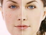 Acne Plr Articles V17