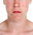 Acne Plr Articles V18