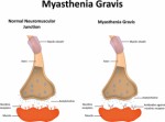 Myasthenia Gravis Plr Articles