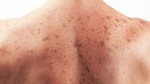 Skin Cancer Plr Articles V3