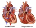 Congestive Heart Failure Plr Articles