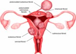 Fibroids Plr Articles