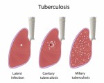 Tuberculosis Plr Articles