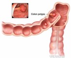 Colorectal Disease Plr Articles