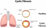 Cystic Fibrosis Plr Articles V2