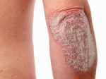 Psoriasis Plr Articles V2