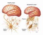 Alzheimers Disease Plr Articles