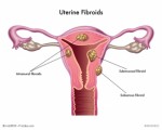 Fibroid Tx Plr Articles
