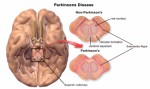 Parkinson Disease Plr Articles