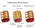 Crohns Ibd Plr Articles